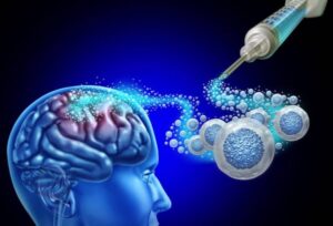 Stem Cell Therapy for Neurological Disorders